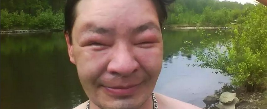 Отеки после употребления алкоголя